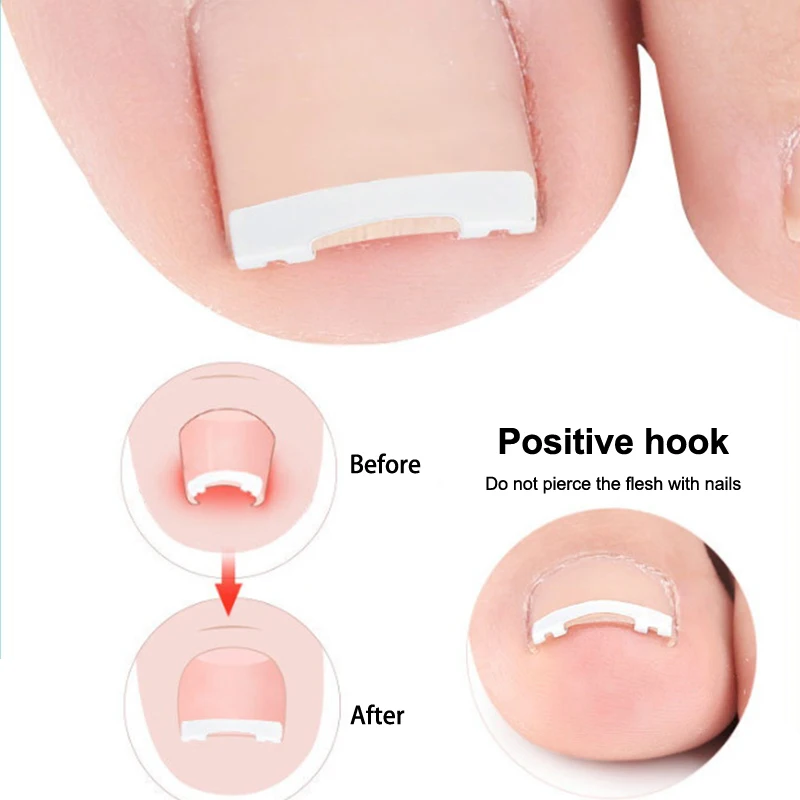 내성발톱 교정기 도구 1개, 페디큐어, 내성발톱 치료, 전문가용 내성발톱 교정, 발 관리