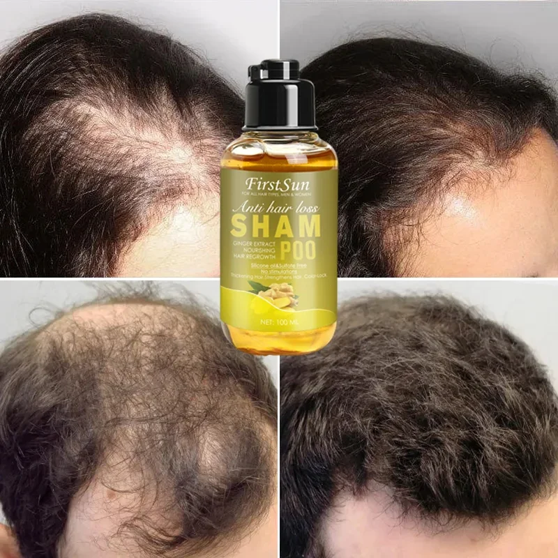 

Unisex Shampoo Against Hair Loss Mild Treatment Ginger Shampoo Anti Hair Loss Ginger Shampoo Hair Growth Products