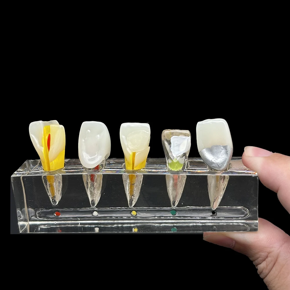 Modelo de dientes dentales, modelo de tratamiento endodóntico, modelo de tratamiento de conducto radicular, modelo Endo de odontología, Material de laboratorio