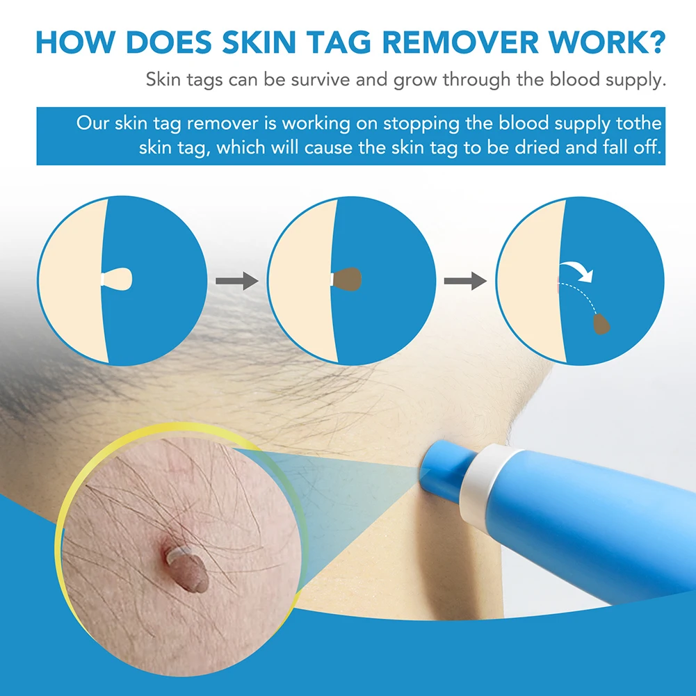 2 IN 1 Auto Skin Tag Remover Micro Skin Tag Removal Device Painless Double Headed Wart Removing Pen Set Face Care Beauty Tools