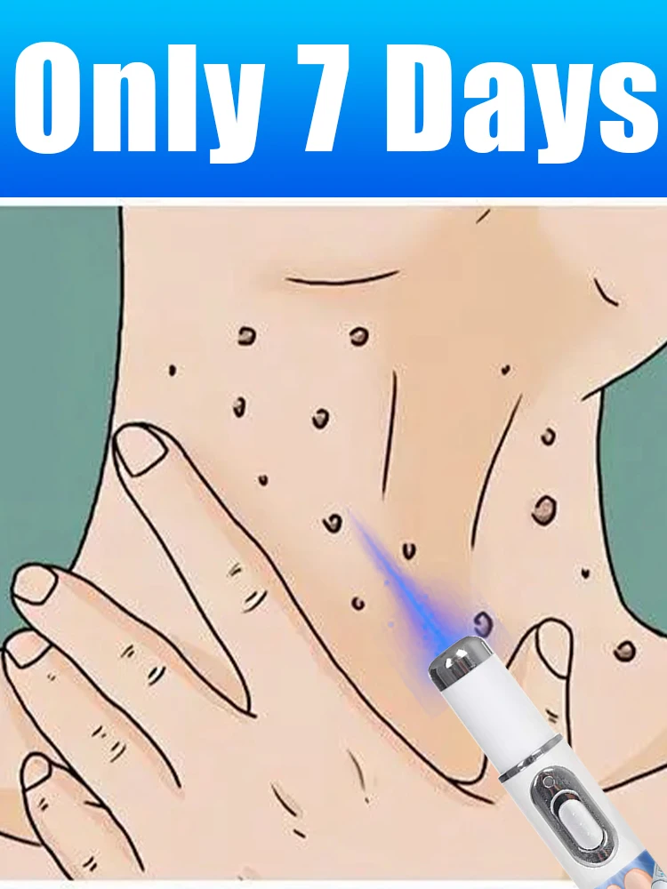 Blaulichtstift löst verschiedene Warzen, heiße Verkaufs-Beinpflegewerkzeuge