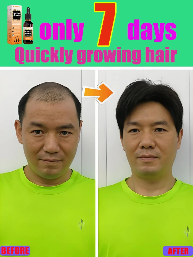 Hᴀɪʀ ɢʀᴏᴡᴛʜ ᴀɢᴇɴᴛ, ғᴀsᴛ ɢʀᴏᴡᴛʜ, ʜᴀɪʀ ʀᴇɢᴇɴᴇʀᴀᴛɪᴏɴ, ʜᴀɪʀ ғᴏʟʟɪᴄʟᴇ ɴᴏᴜʀɪsʜɪɴɢ ᴇssᴇɴᴄᴇ, ᴀᴠᴀɪʟᴀʙʟᴇ ғᴏʀ ᴍᴇɴ ᴀɴᴅ ᴡᴏᴍᴇɴ