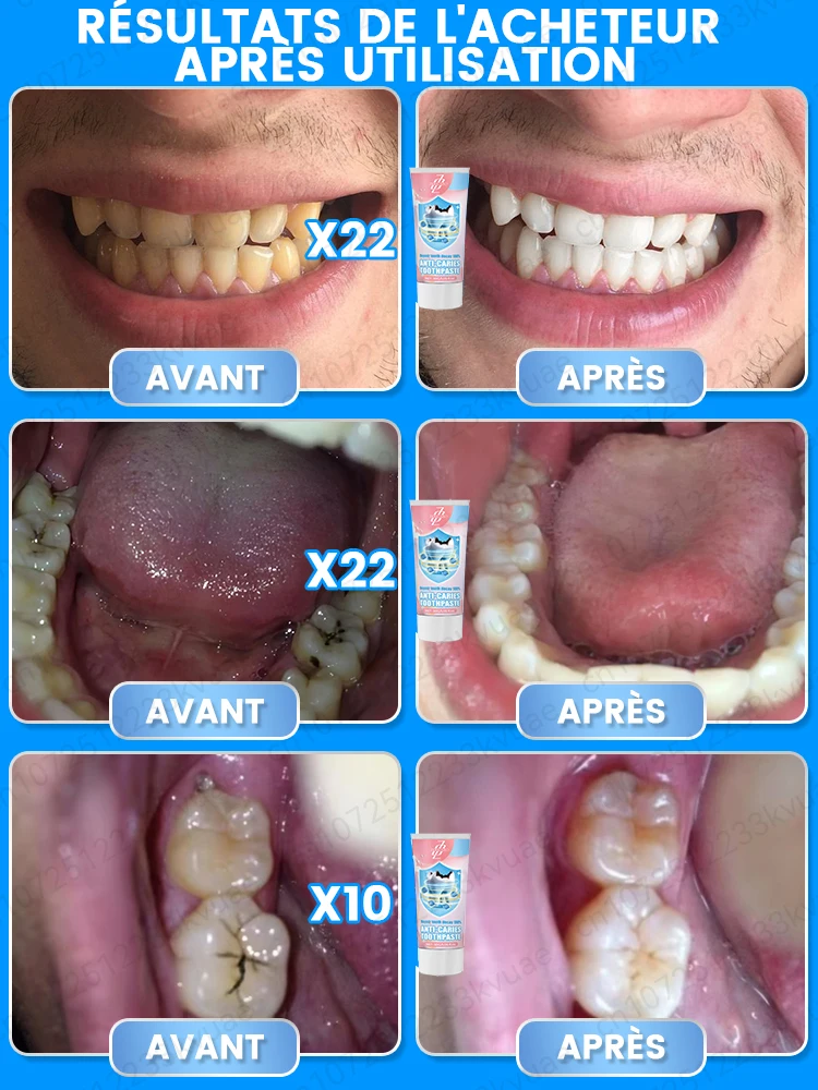 Creme dental anticárie remineralização recuperação esmalte reparação fortalecimento restauração cárie proteção dental dentes