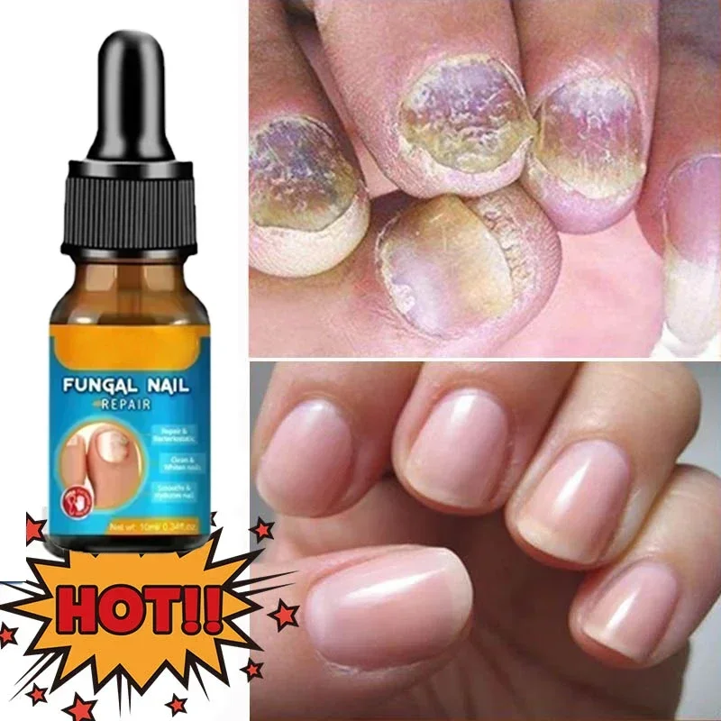 Nail Fungus Treatment Oil Onychomycosis Cleaning Solution Thickening Nail Anti Infection Toe Fungal Extra Strong Removal