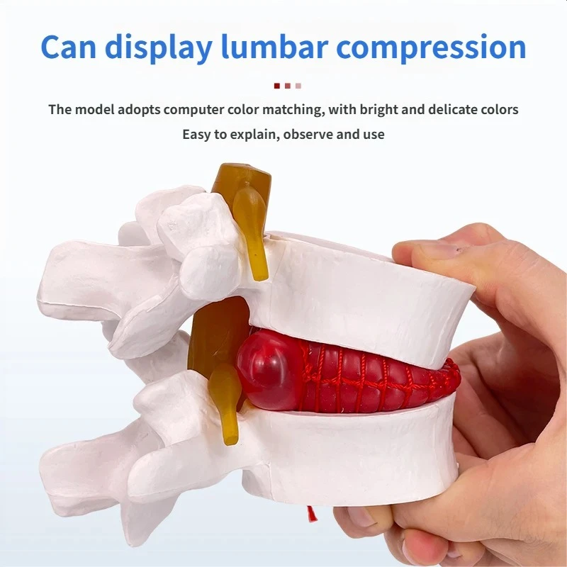 1.5X Human Anatomical Lumbar Disc Herniation Model, Movable Human Lumbar Disc Herniation Model Teach Demonstrating Tool