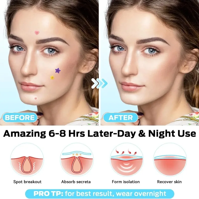 200개 컬러풀 여드름 패치 스티커 방수 여드름 제거 패치 항여드름 하이드로콜로이드 패치 스팟 마크 수리 스티커