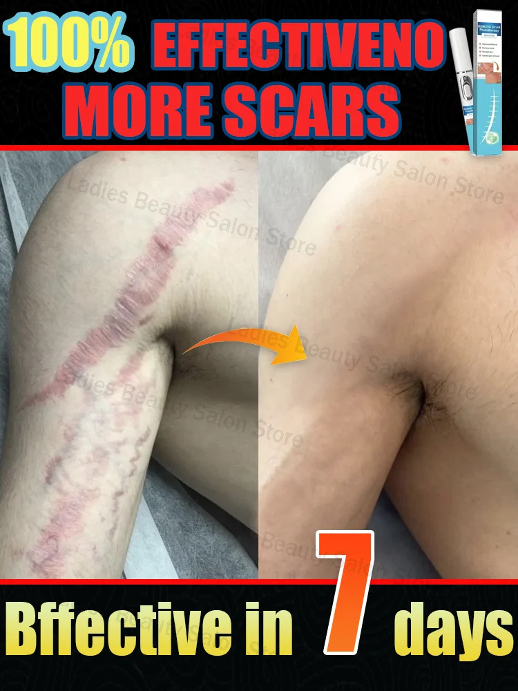 Scars disappear