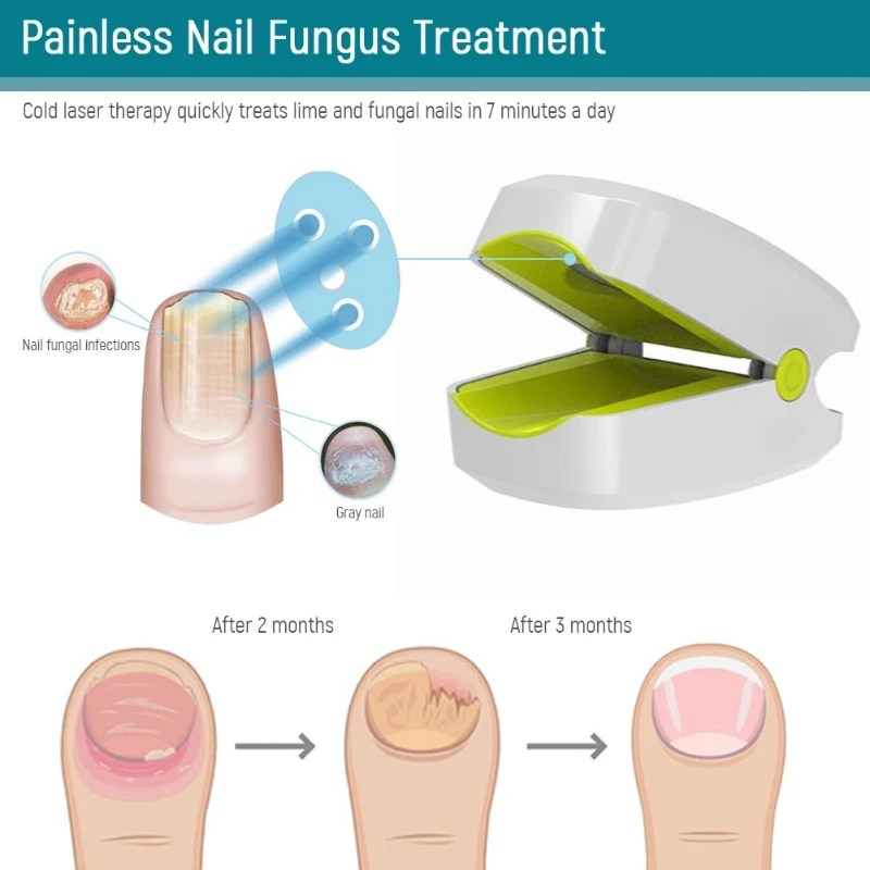 

Time Display Nail Fungus Laser Device 905nm 470nm Fungus Treatments Instrument USB Charging Anti Infection Cure Machine
