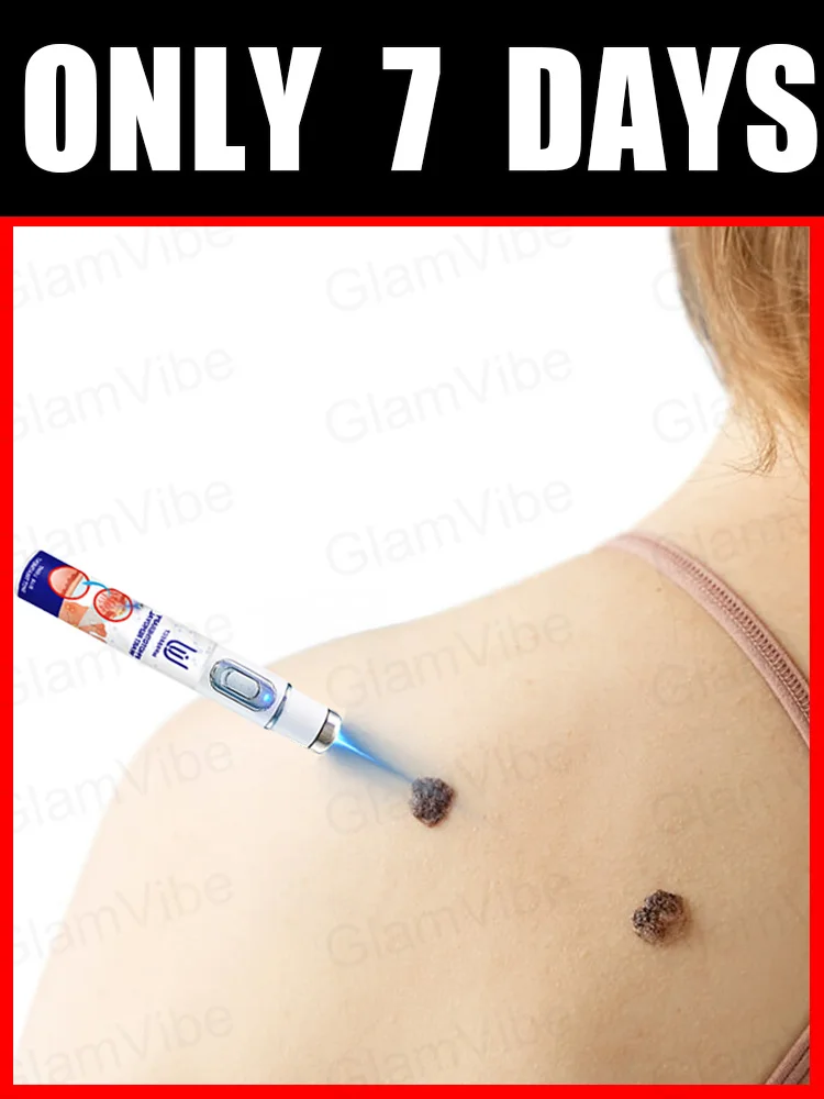 

blue light pen solve warts, hot sale wart care tools