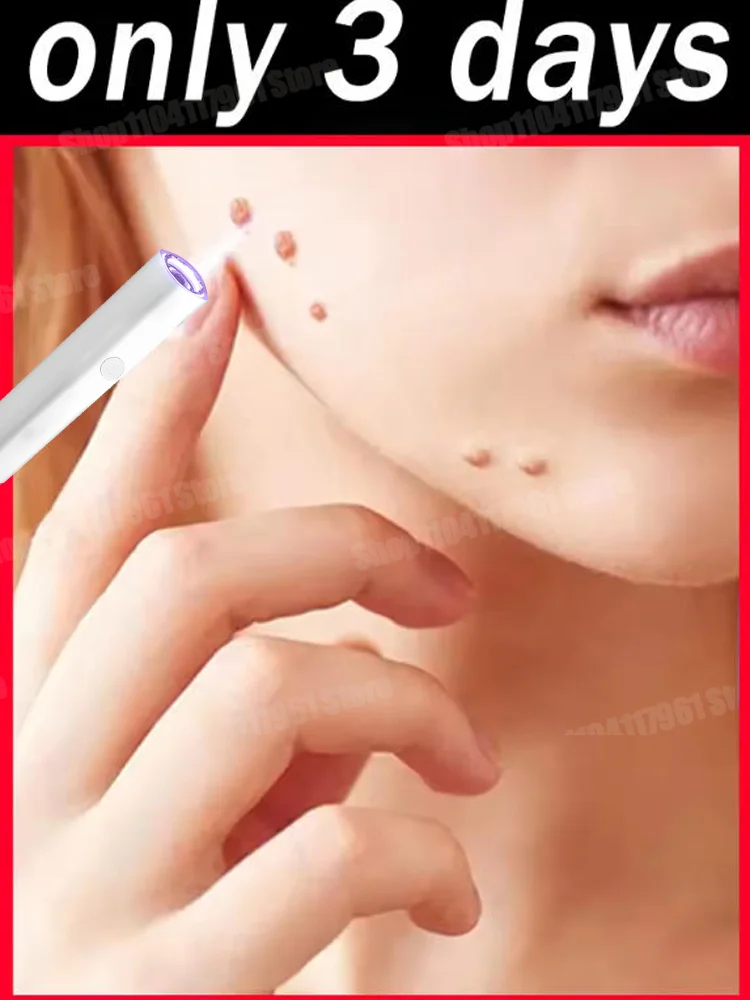 Verruche améliorée de 2e génération réparer la racine des verrues uickly