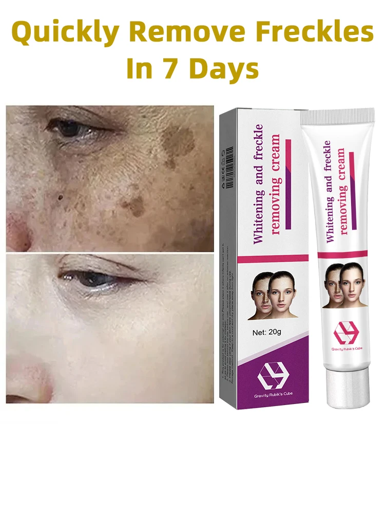 

Freckles Removal Melasma Cream Dark Spot Remover For Face