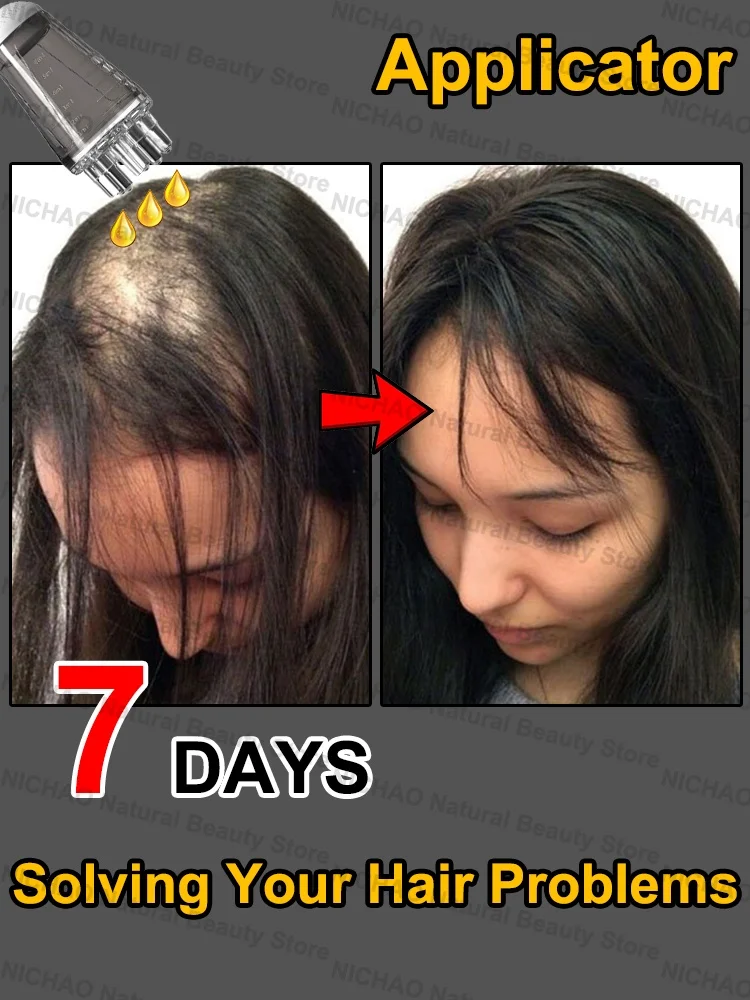 

7 Days Fast Hair Growth Essential Loss Regrowth Treatment Strengthens Hair Nourishes Scalp Light Weight Non Greasy
