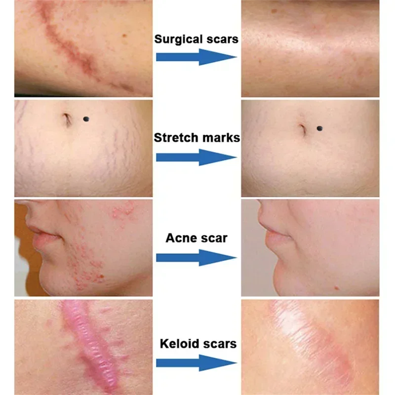 NewScar krim penghilang bekas luka Gel, krim perbaikan penghilang bekas jerawat, penghilang noda jerawat, krim penghalus kulit