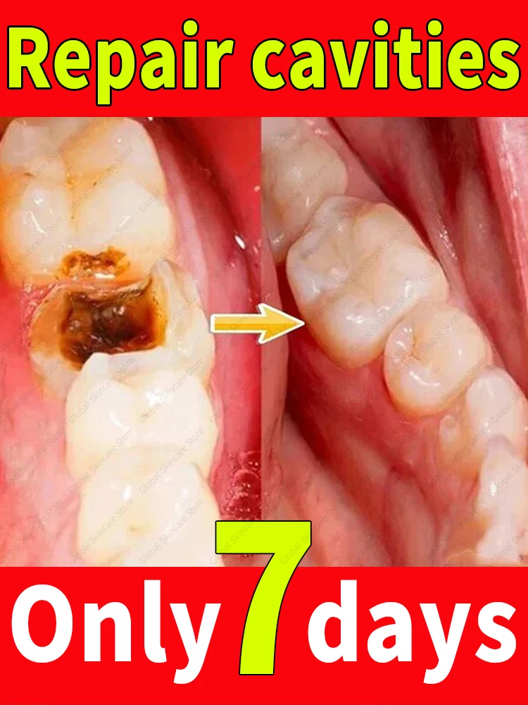 

Solves caries and teeth decay problem