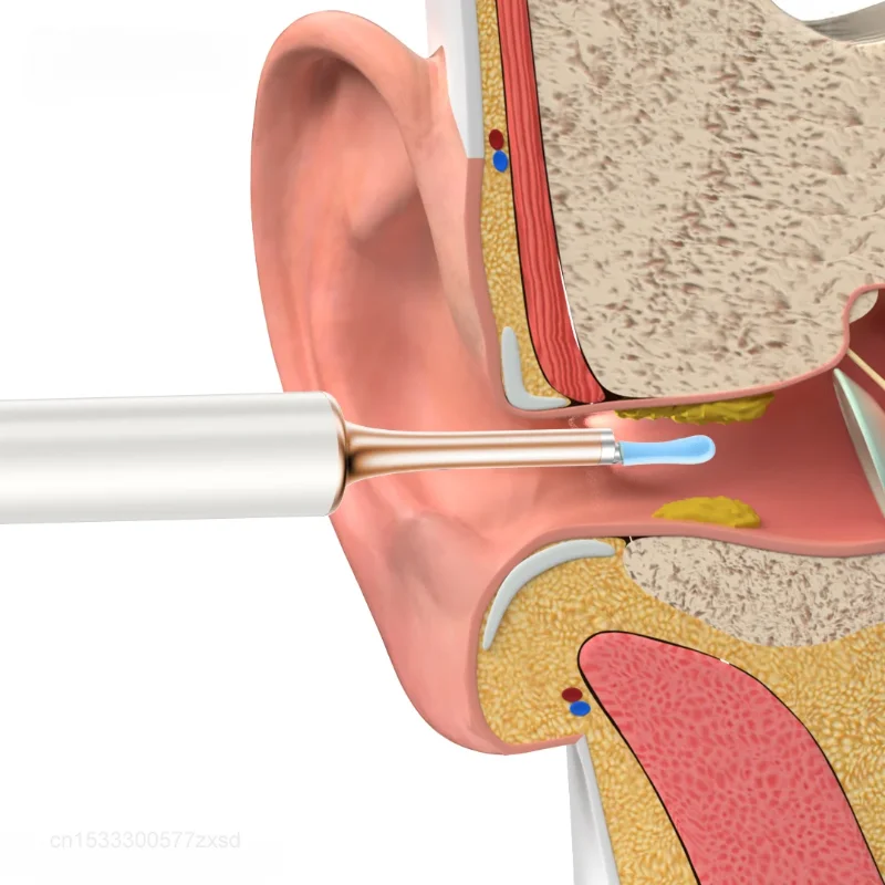 Xiaomi Bebird T15 Pulitore visivo intelligente per le orecchie Endoscopio HD multifunzionale Pick per orecchie luminose per la casa Mini strumenti di pulizia portatili