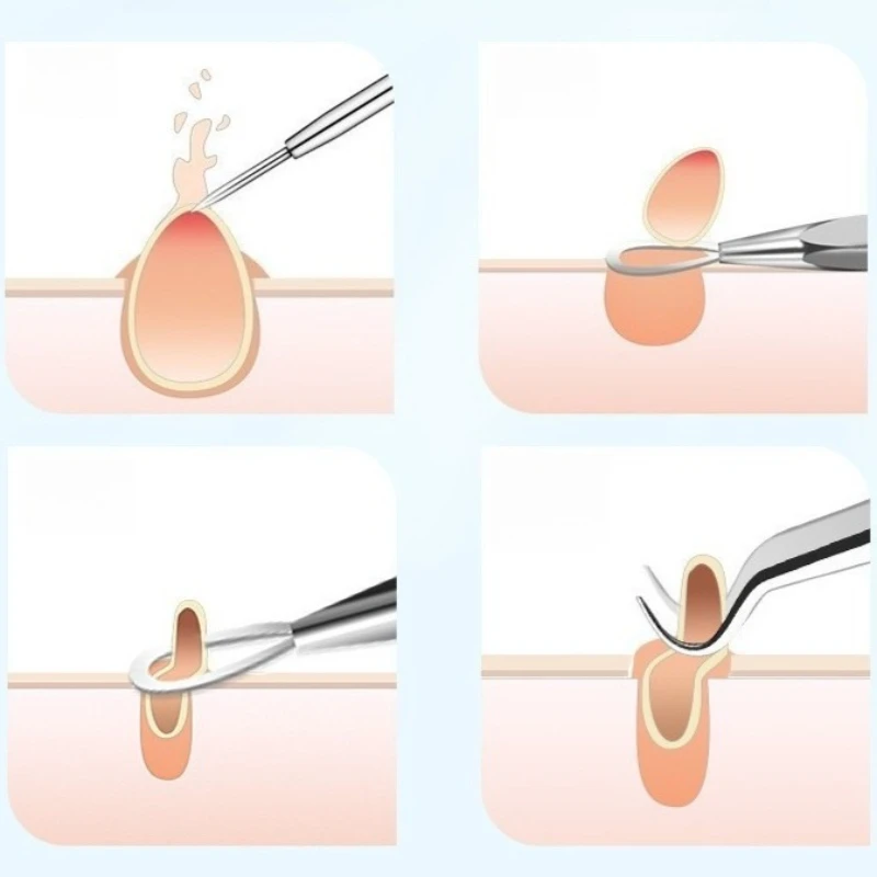 1/2 pz Doppio Anello di Rimozione di Comedone Popper Acne Comedone Blemish Brufolo Estrattore In Acciaio Inox di Rimozione di Comedone Viso pulito