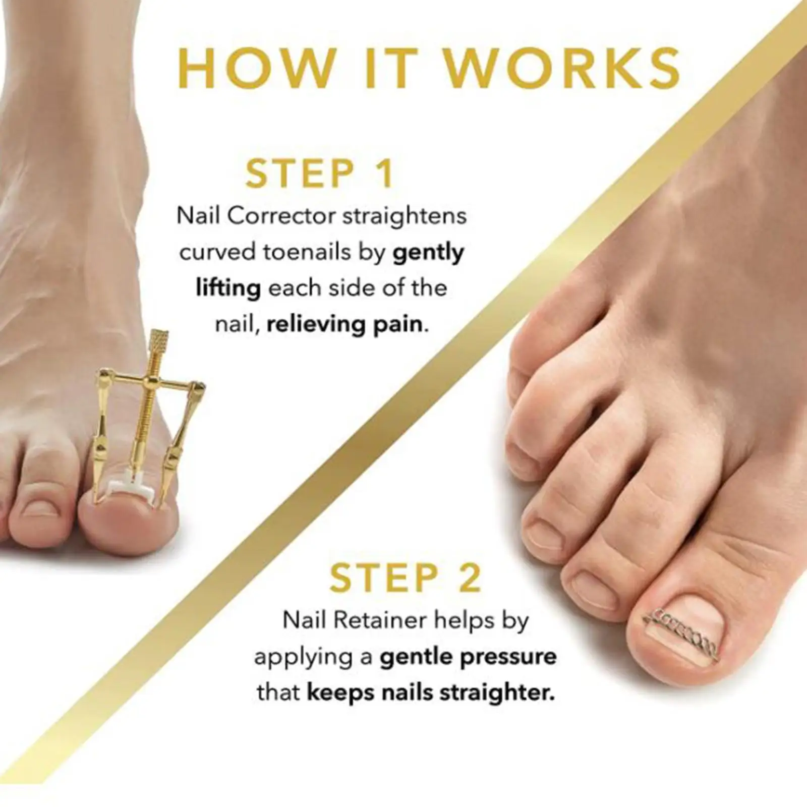 علاج أظافر القدم الغارزة، مشبك تنعيم للأظافر