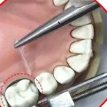 

Стоматологический формовочный кусок клипса Tofflemire Matritzenspanner Стоматологический фиксатор матрицы Стоматологический стоматологический инструмент