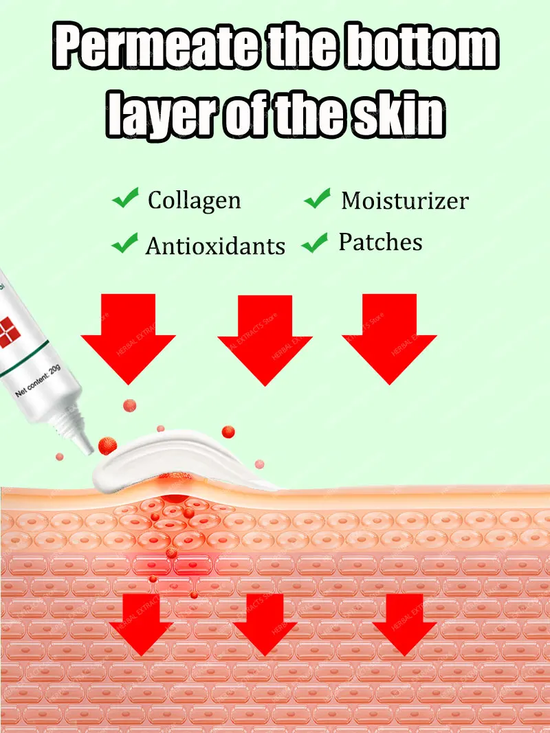 

Acne treatment face cream anti scars for pimples removal on product