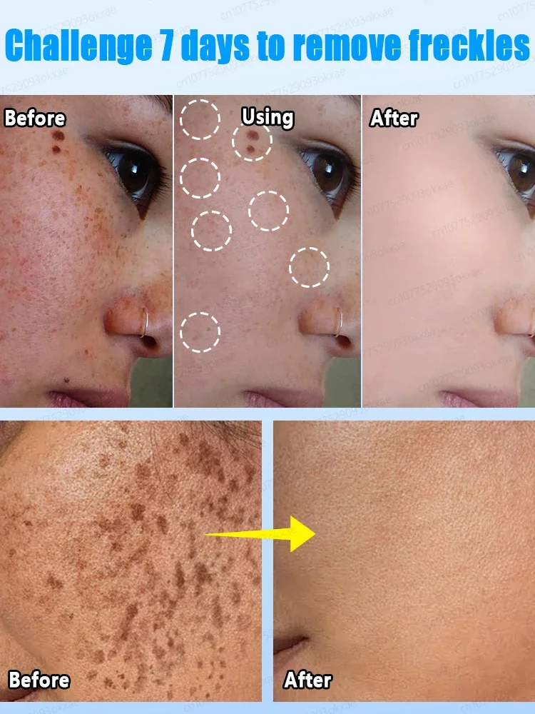 Esencia para eliminar pecas, manchas oscuras, cloasma, pecas, eliminación de manchas pigmentadas de la edad.