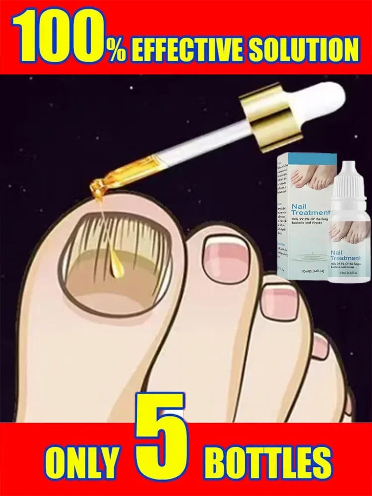 Fungal Nail Removal 10ML Fungal Nail Treatment Oil Foot Repair Essence Toe Nail Fungus Removal Gel Anti Infection Cream