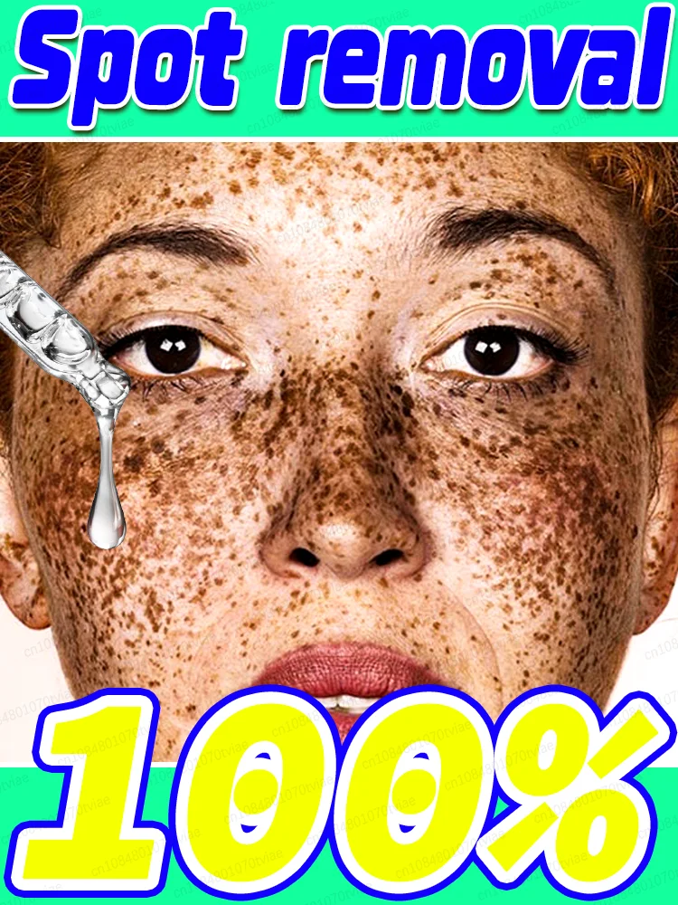 

Fʀᴇᴄᴋʟᴇ ʀᴇᴍᴏᴠᴀʟ Pigmentation effectively disappears, skin is 100% effective, clean and smooth skin on the face