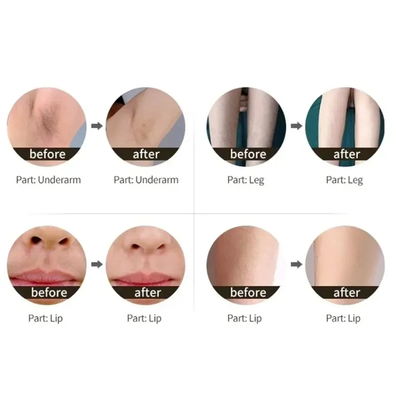 Diode Laser Hair Removal Machine Professional Man Laser Almalasers Ice Titanium 808 Nm1064 Nm Laserhairremoval Machine