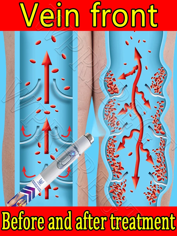 

Лазерная указка второго поколения: лечение варикозного расширения вен