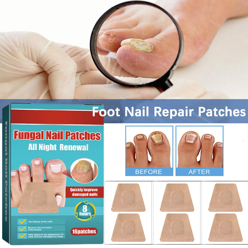 16/32 قطعة القدم مسمار تصحيح ملصق رقعة إصلاح الأظافر الفطرية سماكة لينة علاج الداحس مقاوم للماء لزجة العناية بالقدم #2