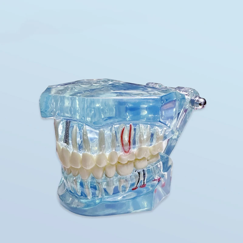 Modelo de restauração dentária, ensino dentário, modelo dentário destacável com modelo ortodôntico nervoso, produtos odontológicos