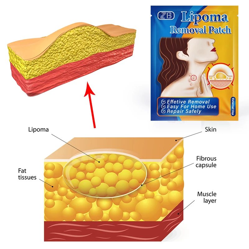 6 шт. паста для удаления липомы, пластырь для удаления груди, артикул: YG-2059@ # SMT1234yjz