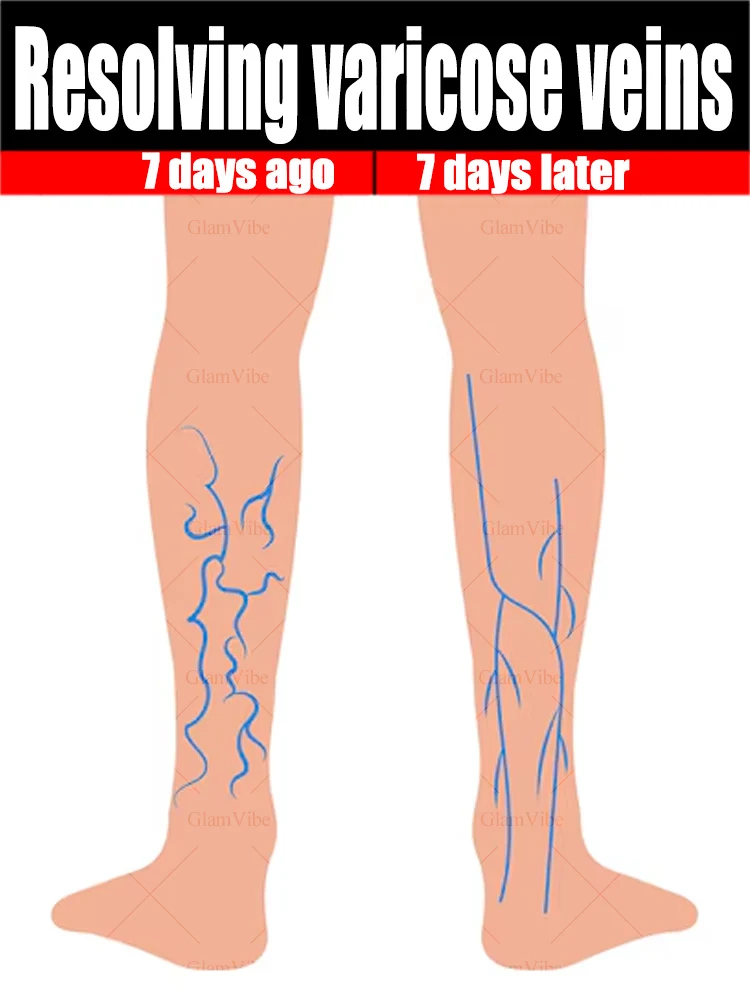 Terapia a laser de segunda geração pode ajudá-lo a remover pernas de aranha e varizes em apenas 7 dias.