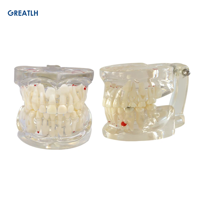 Dental Clear Mixed Age Model Extraction Model Dental Teeth Model Clear Mixed with Missing Teeth Model Dental Materials