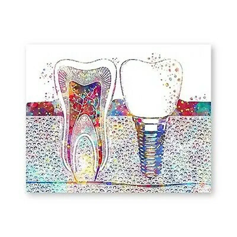 Tooth Implant Dentist Hospital Dental Clinic Medicine Wall Art Pictures Posters Canvas Paintings Room Decorations Home Decor