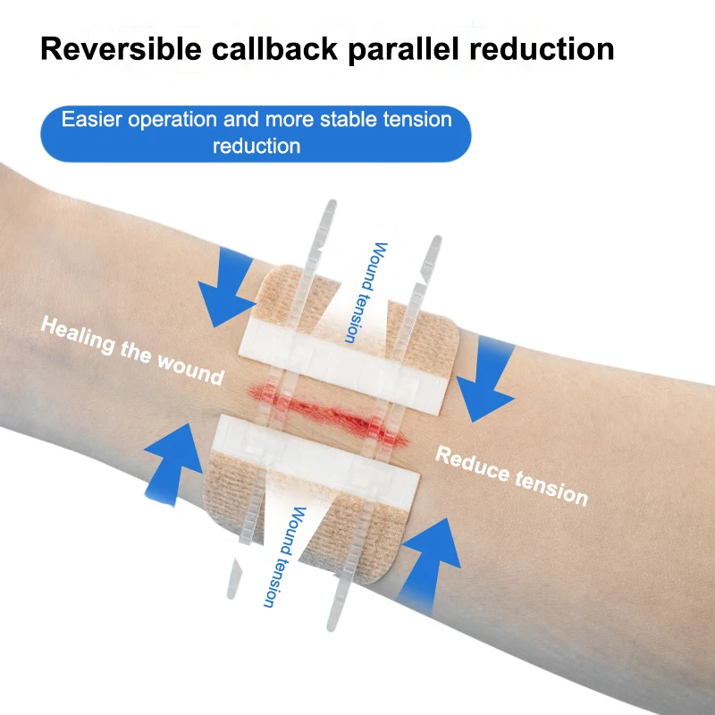 New Elastic Strap Zipper Tie Wound Closure Patch Adhesive Tape Wound Fast Without Suture Zipper Tape Skin Wound Dressing