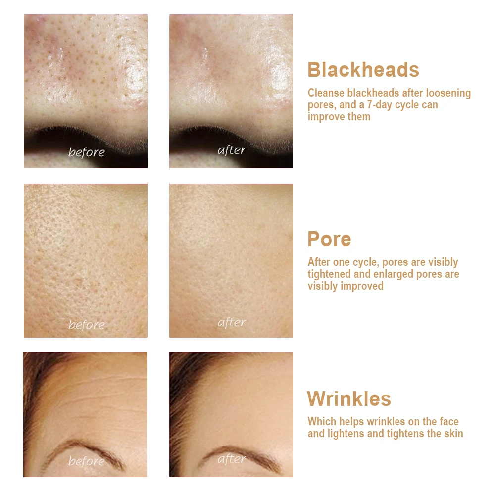 เครื่องขัดผิวแบบอัลตร้าโซนิคเครื่องขัดผิวหน้าเครื่องขัดสิวหัวดำพลั่วปอกเปลือกทำความสะอาดเครื่องดูดสิวดูแลผิว