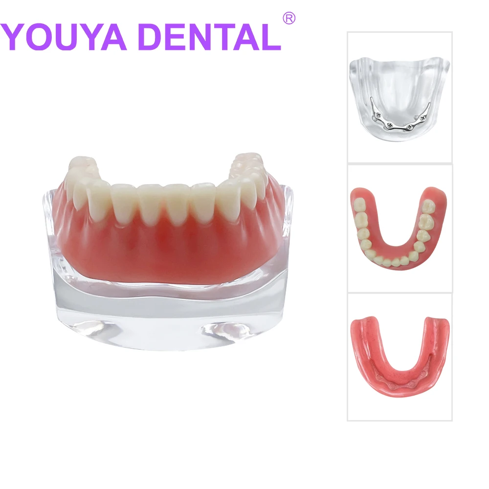 

Dental Implant Overdenture Teeth Model M6008 4 Implants Superior Upper Inferior Lower Restoration Model Dentist Teaching Display