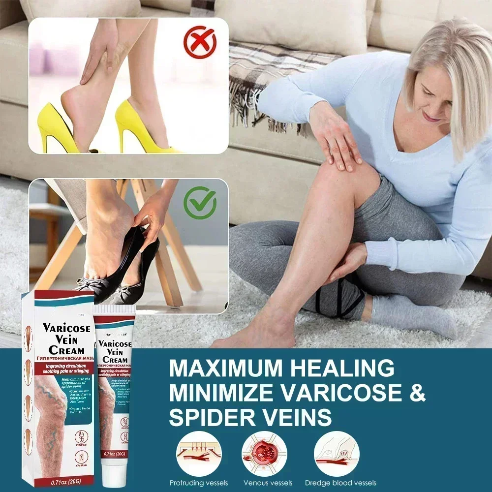 HOT SALE Varicose Veins Treatment Cream Angiitis Legs Dilated Relief Vasculitis Phlebitis Spider Leg Varicosity Foot Care Medici