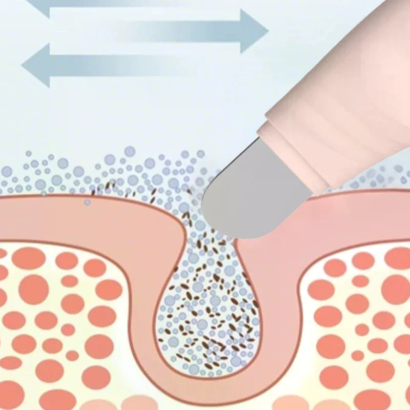 Herramienta de eliminación de espinillas faciales, raspador Facial para limpieza profunda, espátula para base de acné, eliminador de espinillas de nariz, herramienta para el cuidado de la piel