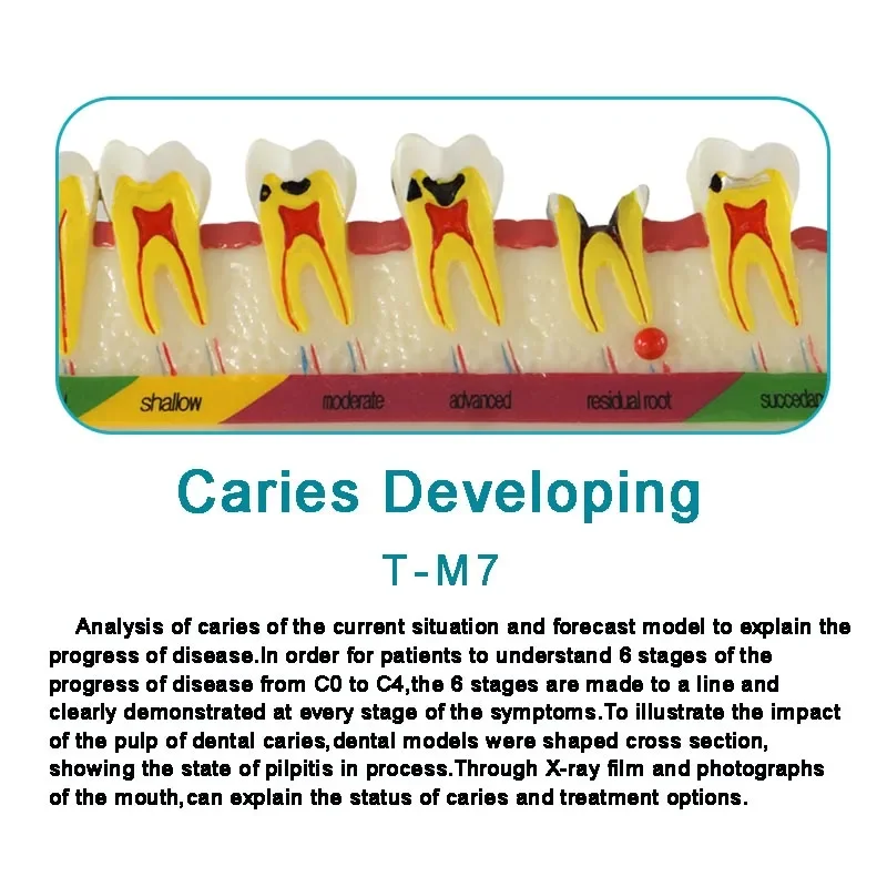 

Dental Teeth model Caries Analysis Model Dental Demonstration Teeth Model Disease Model