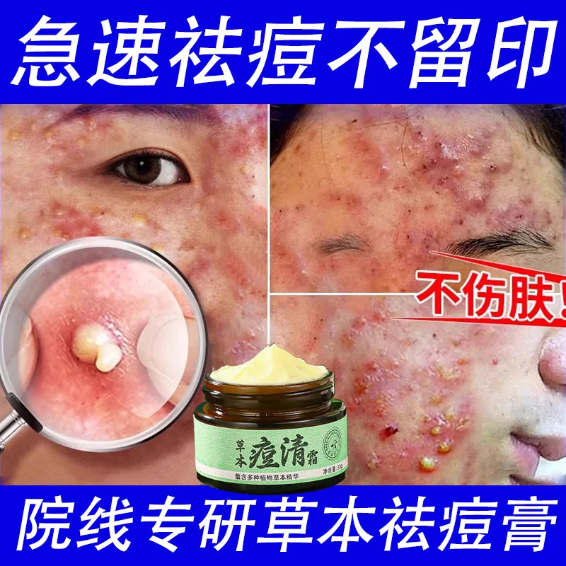 

Herbal acne cream powerful acne removal moisturizing exfoliating shrinking pores closing removing fading acne marks Skincare