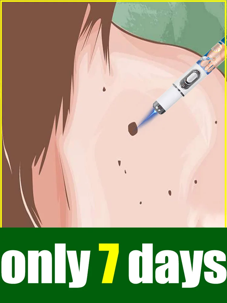 

2025 5th Generation Solve Wart Tools blue laser pointer 1 week Lots of discounts