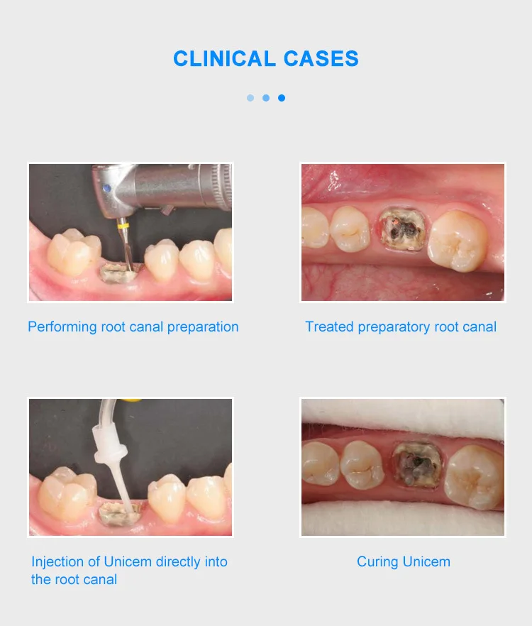 20 قطعة/صندوق ألياف الأسنان آخر التدريبات المسمار الموضوع الكوارتز الزجاج كومة عدة قناة الجذر المواد الترميمية 1.2/1.4/1.6/1.8 مللي متر #6