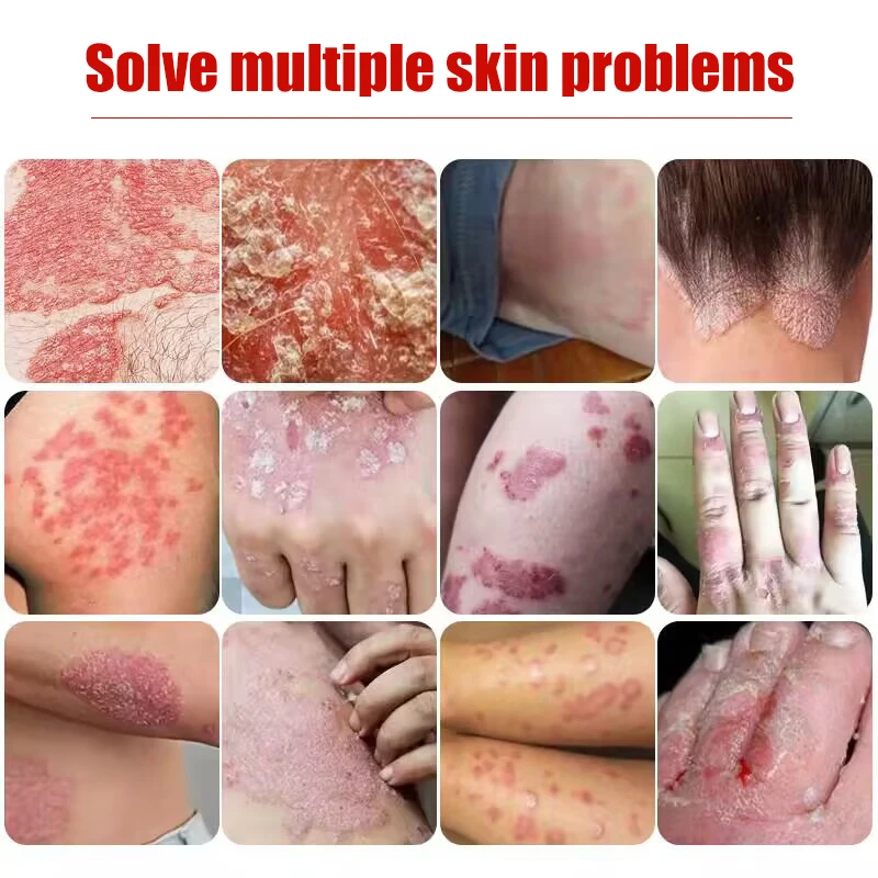 Pomada médica para Psoriasis, crema para Dermatitis alérgica, Eczema, crema para pápulas, infección por hongos, tratamiento de apósito, 20g