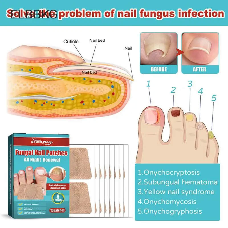 16Pcs/pack Nail Treatment Patch Anti Fungal Nail Correction Stickers Ingrown Toenail Care Paronychia Anti Infection Repair Patch