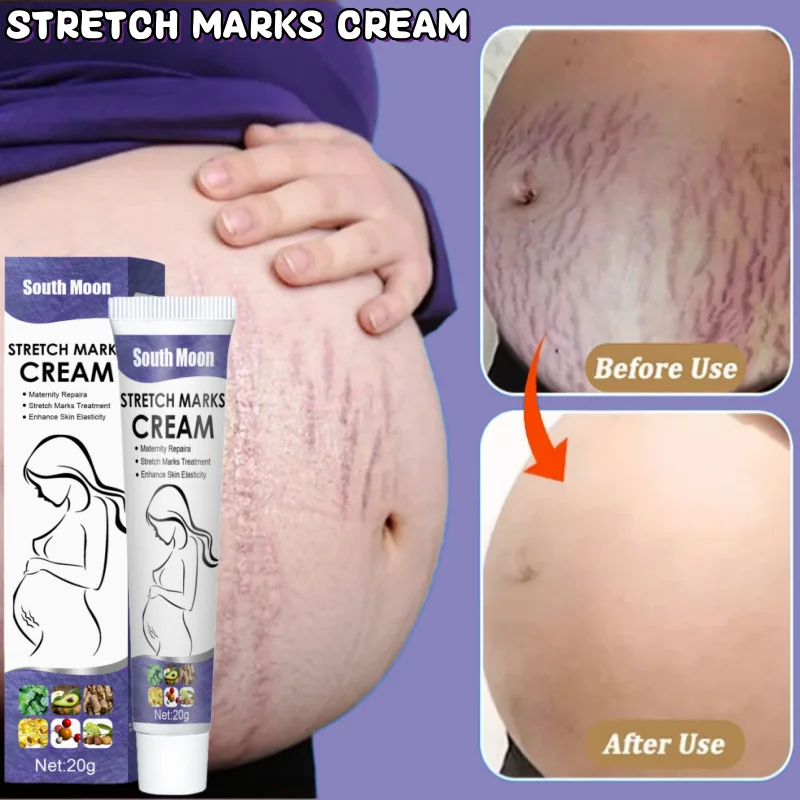 

Stretch Mark Permanent Repair Cream For Pregnant Women Postpartum Care Firm Light Lines Obesity Growth Lines Repair Cream New