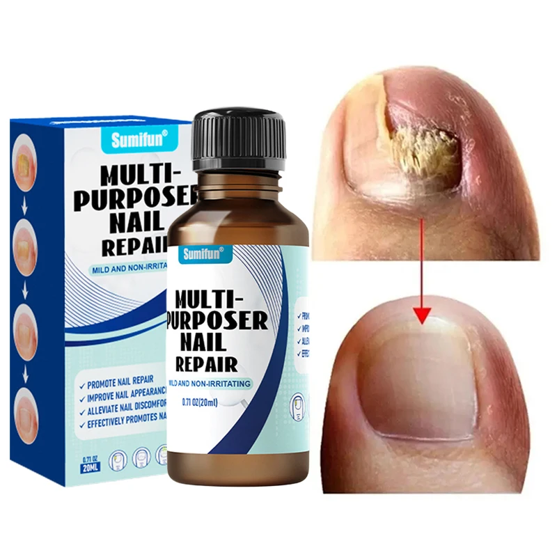 Suero para tratamiento de uñas por hongos, Gel reparador para eliminación de hongos en las uñas de los pies, antiinfección, paroniquia, onicomicosis, esencia para el cuidado de las uñas de los pies