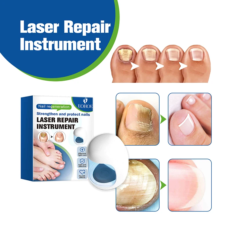 Fungal Toe Nail Device Repair Fast Toenail Nails Fungus Onychomycosis Repair Toenail Fingernail Removes Nail Fungus Treatment