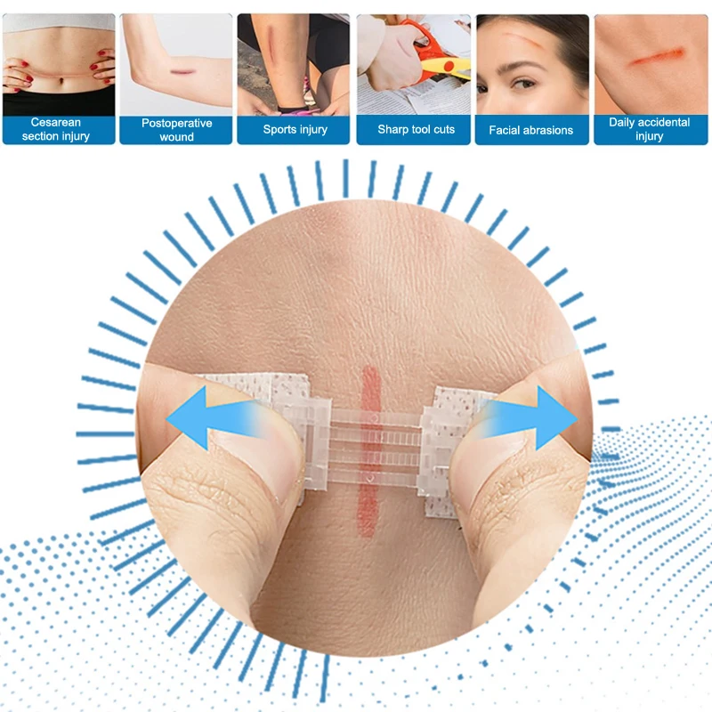 Zipper Tie Wound Closure Patch Hemostatic Patch Wound Fast Without Suture Zipper Outdoor Band-Aid Portable Quick Clot Wound