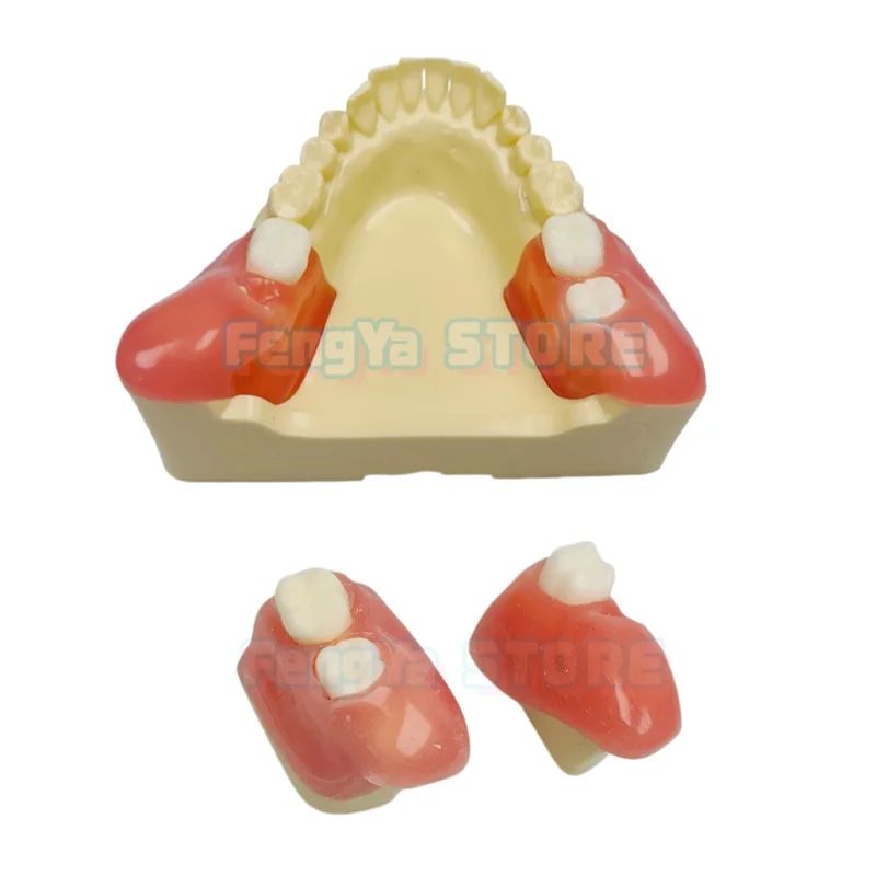 1Pcs/Box Dental Wisdom Tooth Extraction Model Impacted Tooth Model Wisdom Tooth Extraction Practice Model Replaceable Module